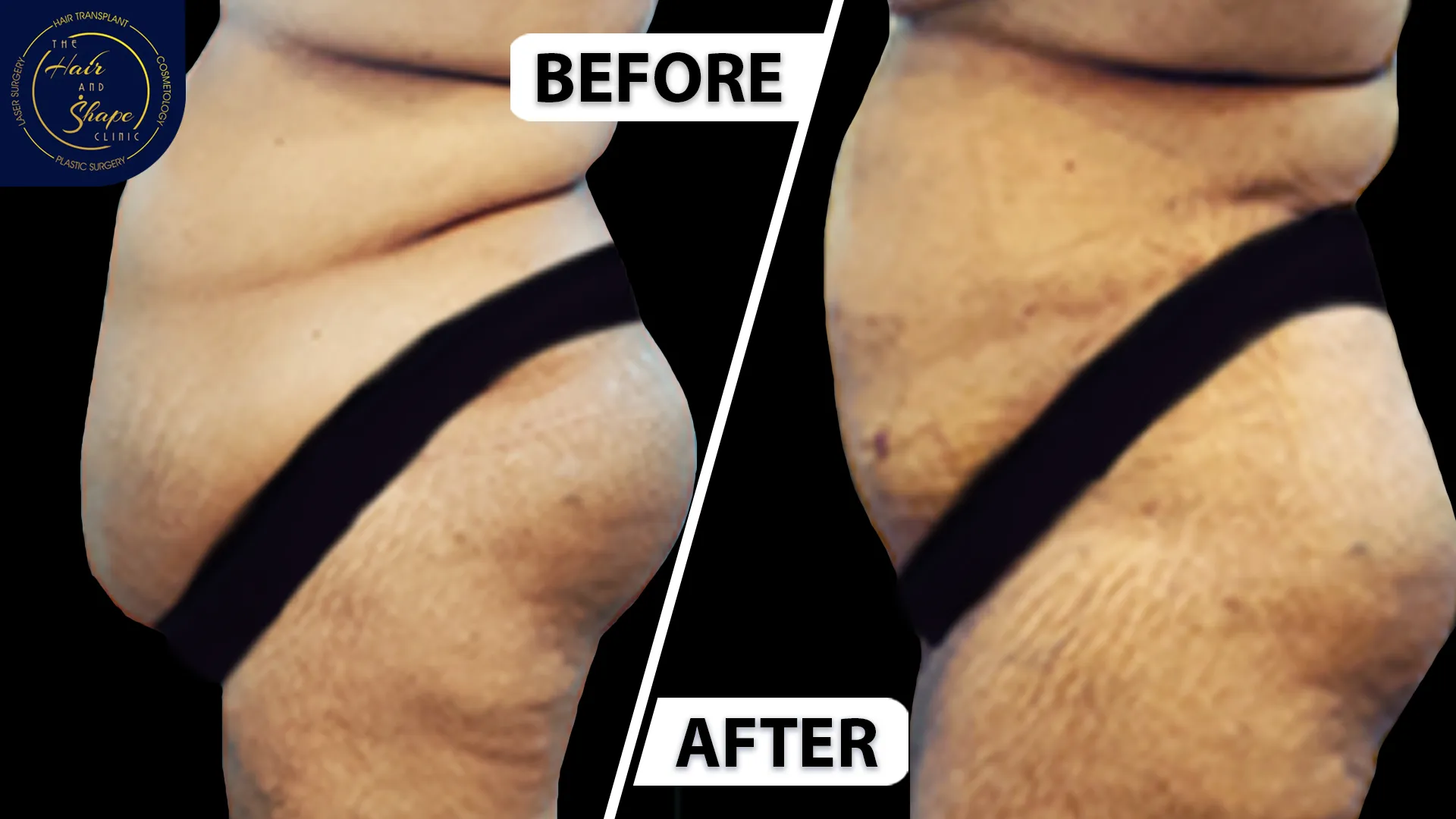 Tummy Tuck result6